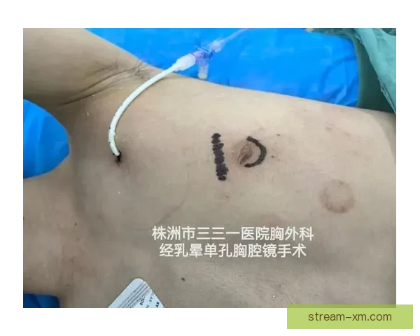 坎宁安气胸康复持续推进 活塞计划一周后复查评估